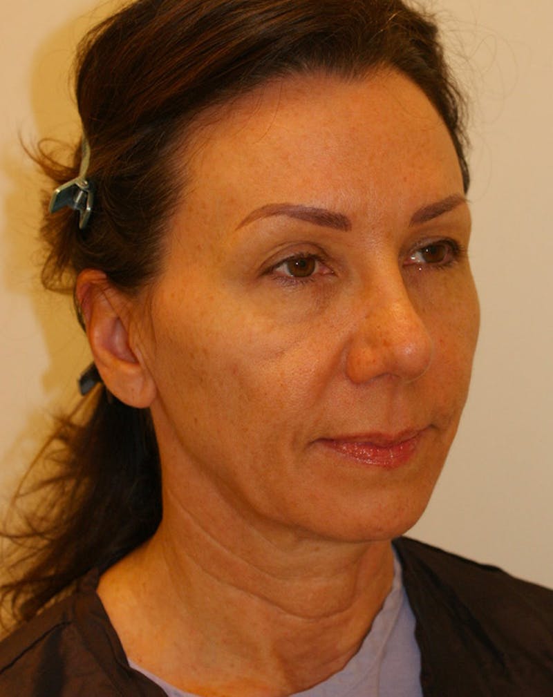 Facelift/Necklift Before & After Gallery - Patient 311795 - Image 3