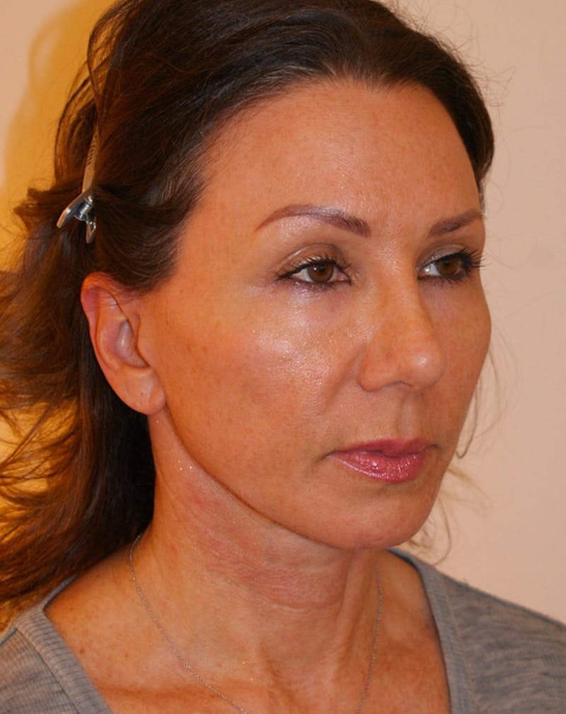 Facelift/Necklift Before & After Gallery - Patient 311795 - Image 4