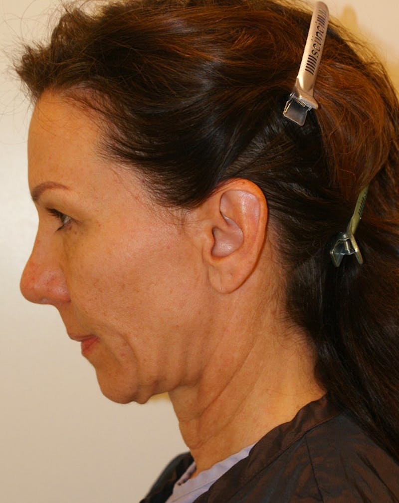 Facelift/Necklift Before & After Gallery - Patient 311795 - Image 7