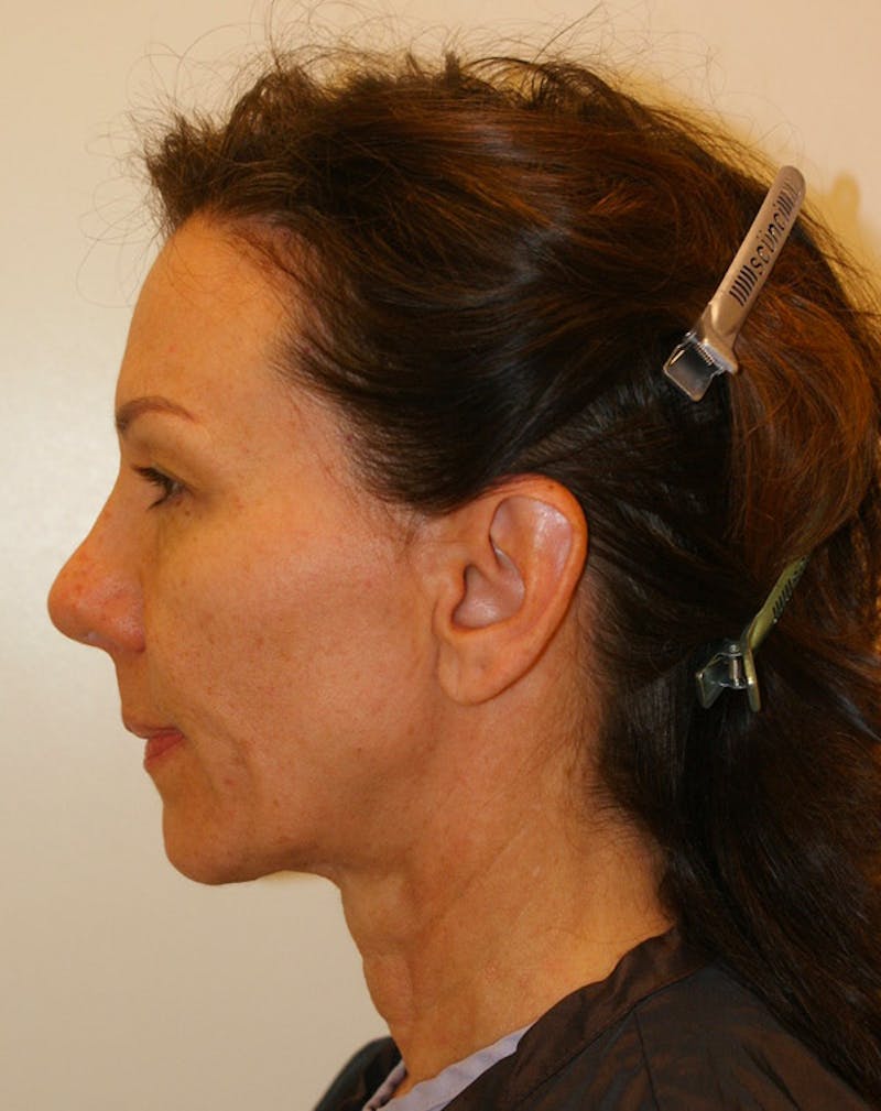 Facelift/Necklift Before & After Gallery - Patient 311795 - Image 5