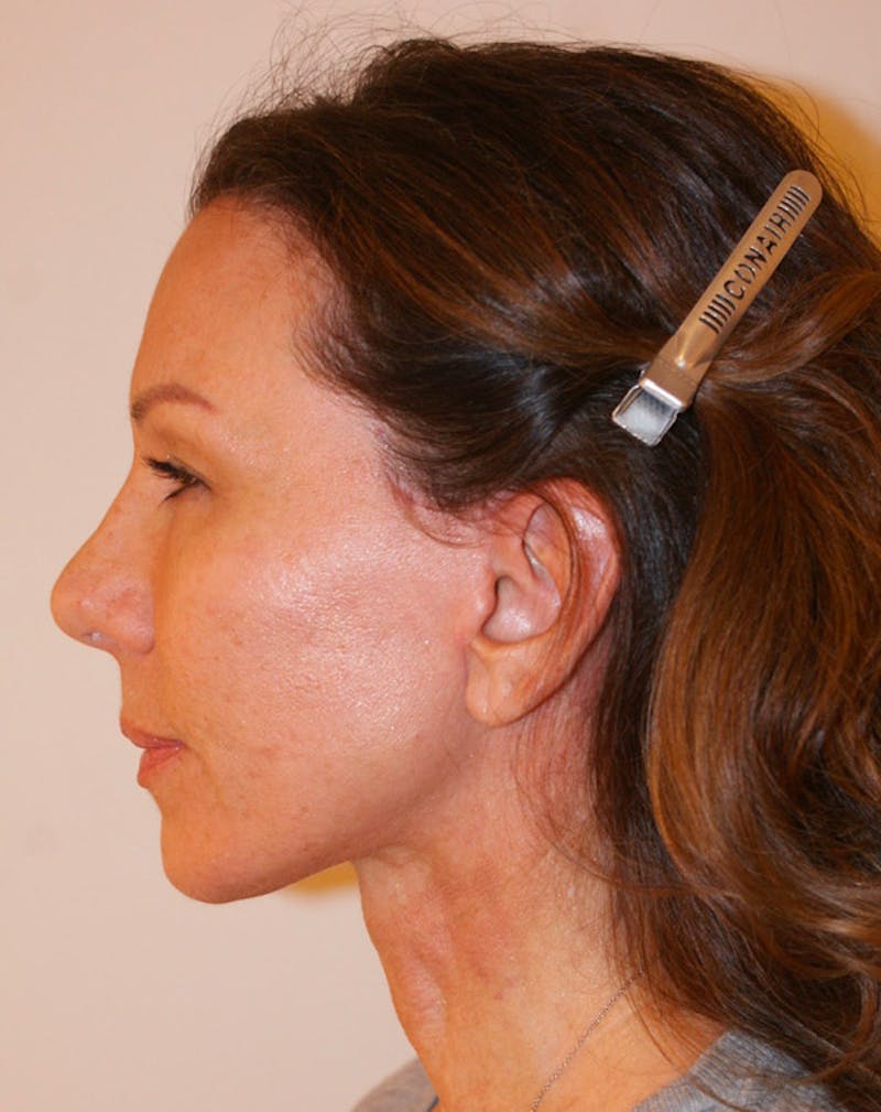 Facelift/Necklift Before & After Gallery - Patient 311795 - Image 6