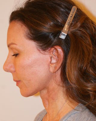 Facelift/Necklift Before & After Gallery - Patient 311795 - Image 8