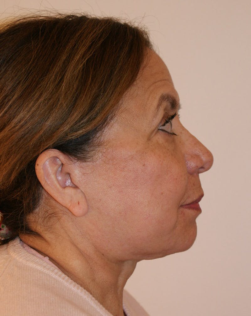 Facelift/Necklift Before & After Gallery - Patient 309875 - Image 6