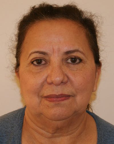 Facelift/Necklift Before & After Gallery - Patient 309875 - Image 1