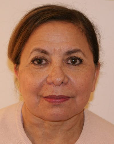 Facelift/Necklift Before & After Gallery - Patient 309875 - Image 2