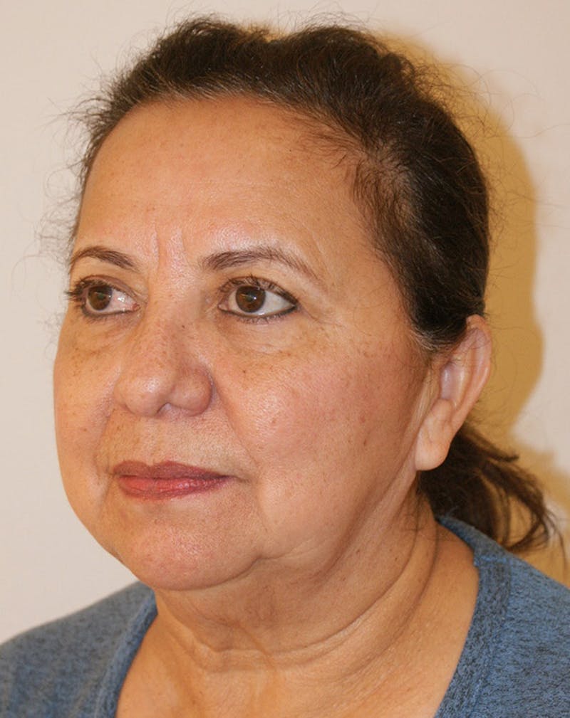 Facelift/Necklift Before & After Gallery - Patient 309875 - Image 3