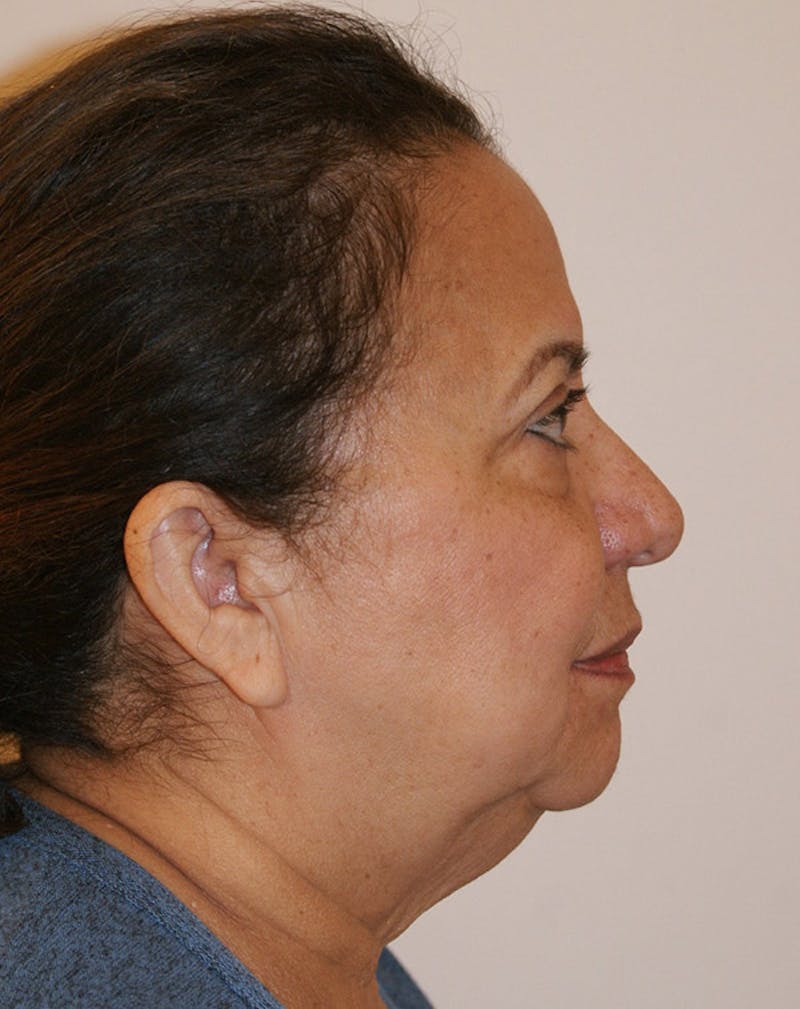 Facelift/Necklift Before & After Gallery - Patient 309875 - Image 5