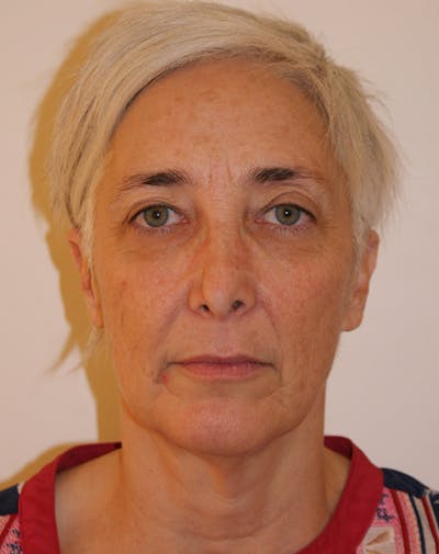 Facelift/Necklift Before & After Gallery - Patient 372877 - Image 1