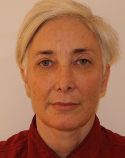 Facelift/Necklift Before & After Gallery - Patient 372877 - Image 2
