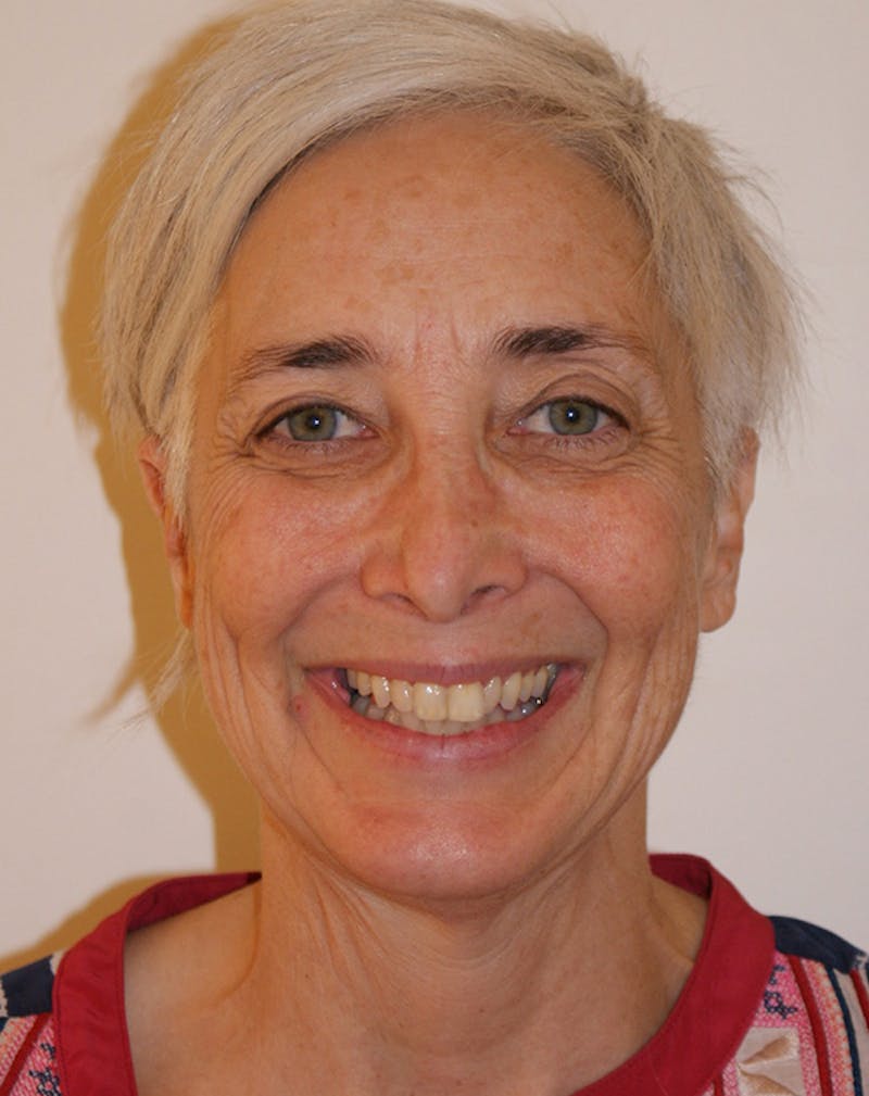 Facelift/Necklift Before & After Gallery - Patient 372877 - Image 3
