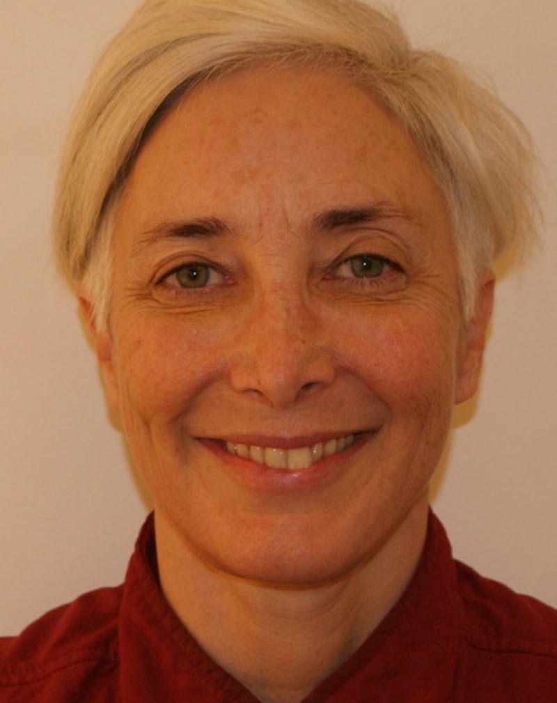 Facelift/Necklift Before & After Gallery - Patient 372877 - Image 4