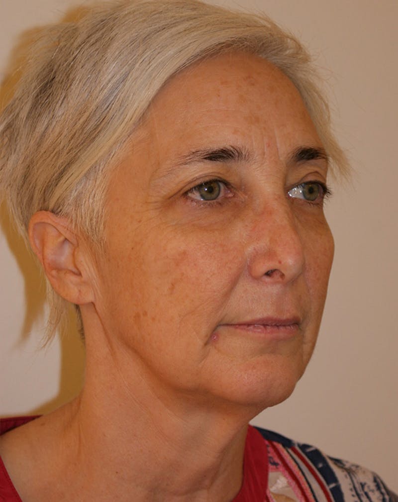 Facelift/Necklift Before & After Gallery - Patient 372877 - Image 5