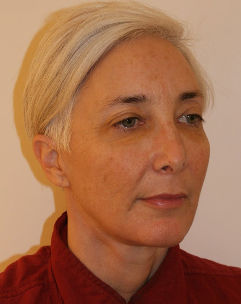 Facelift/Necklift Before & After Gallery - Patient 372877 - Image 6