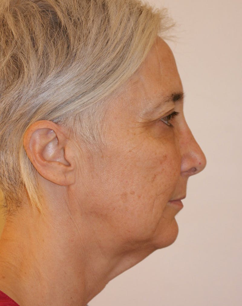 Facelift/Necklift Before & After Gallery - Patient 372877 - Image 7