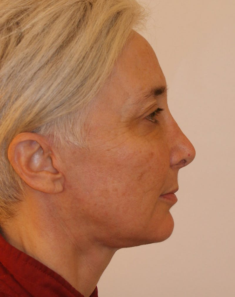 Facelift/Necklift Before & After Gallery - Patient 372877 - Image 8