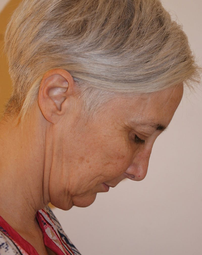 Facelift/Necklift Before & After Gallery - Patient 372877 - Image 9