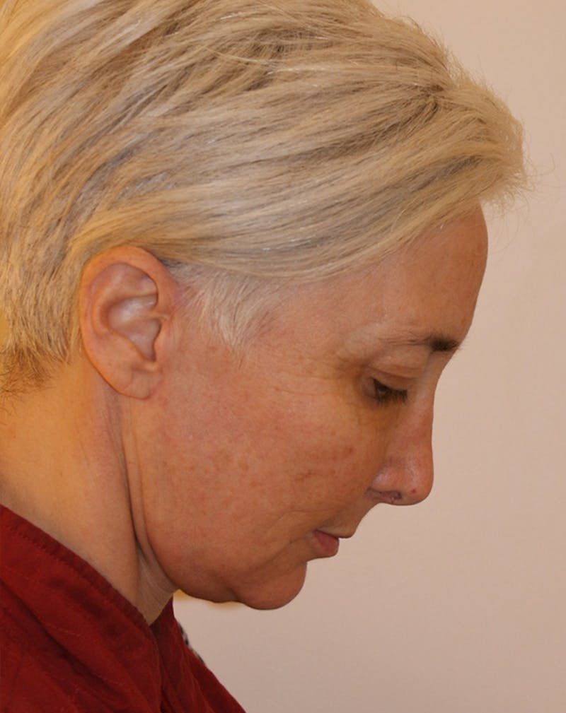 Facelift/Necklift Before & After Gallery - Patient 372877 - Image 10