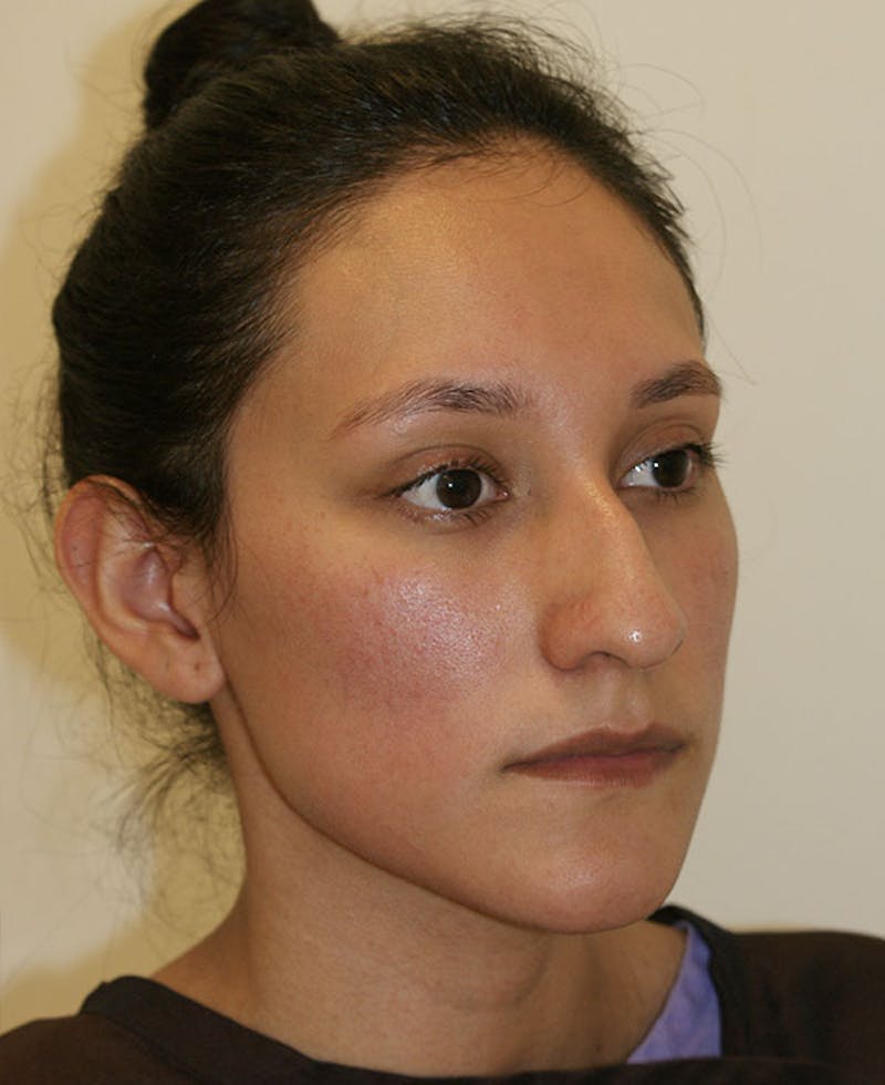 Rhinoplasty Before & After Gallery - Patient 123334 - Image 3