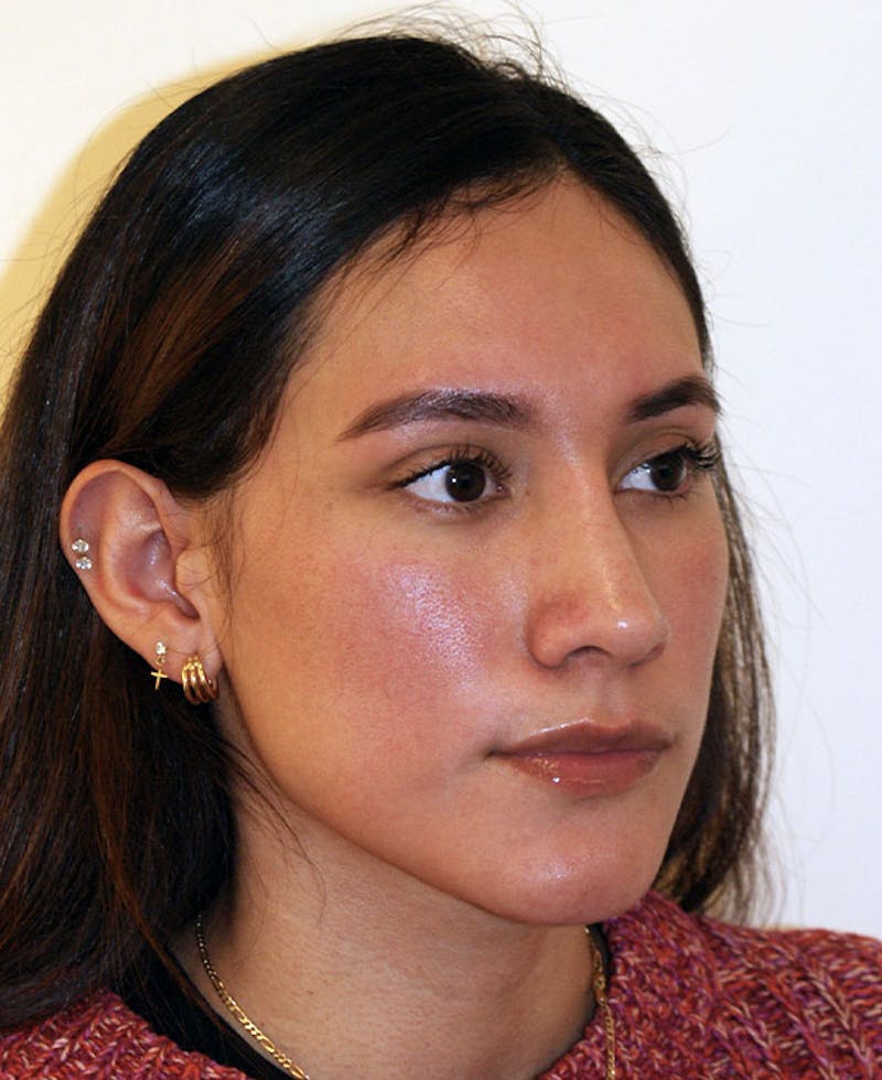 Rhinoplasty Before & After Gallery - Patient 123334 - Image 4