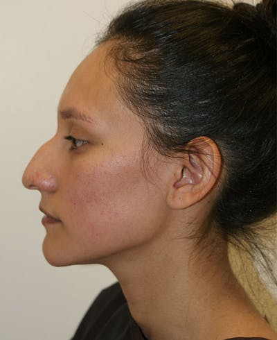 Rhinoplasty Before & After Gallery - Patient 123334 - Image 1