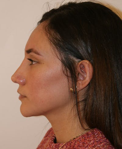 Rhinoplasty Before & After Gallery - Patient 123334 - Image 2
