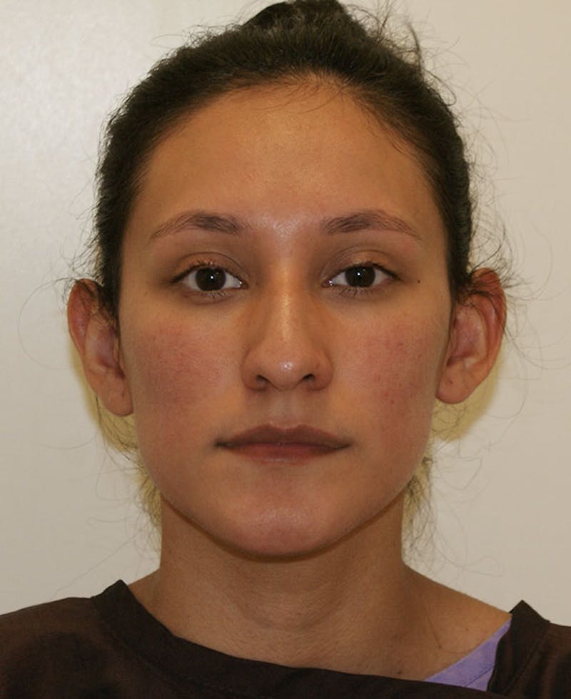 Rhinoplasty Before & After Gallery - Patient 123334 - Image 5