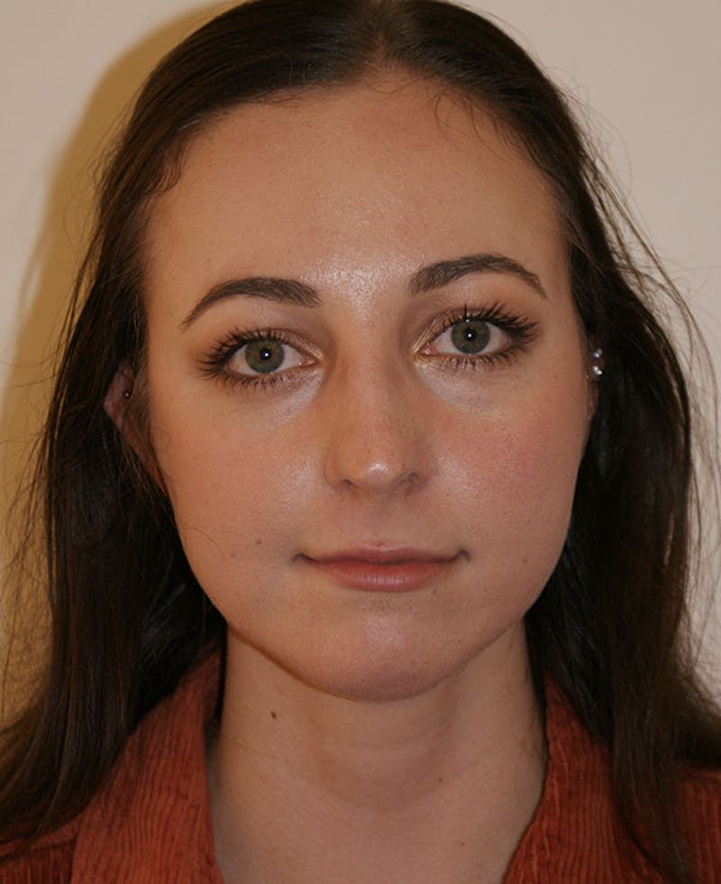 Rhinoplasty Before & After Gallery - Patient 241499 - Image 5