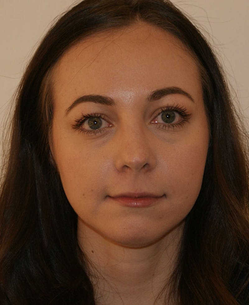 Rhinoplasty Before & After Gallery - Patient 241499 - Image 6