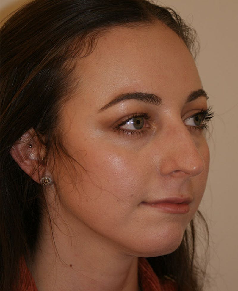 Rhinoplasty Before & After Gallery - Patient 241499 - Image 3