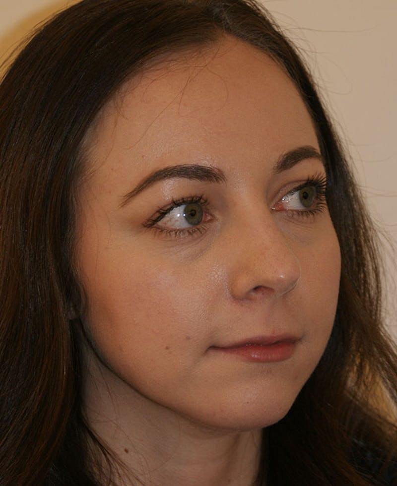 Rhinoplasty Before & After Gallery - Patient 241499 - Image 4