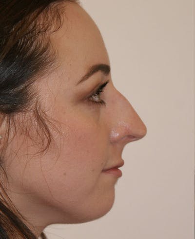 Rhinoplasty Before & After Gallery - Patient 241499 - Image 1