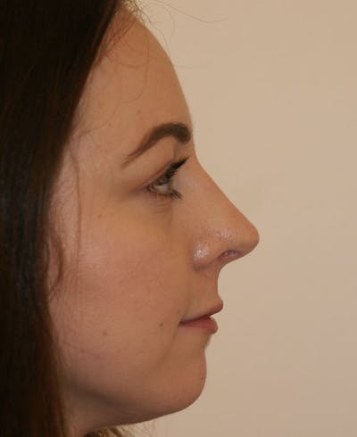 Rhinoplasty Before & After Gallery - Patient 241499 - Image 2
