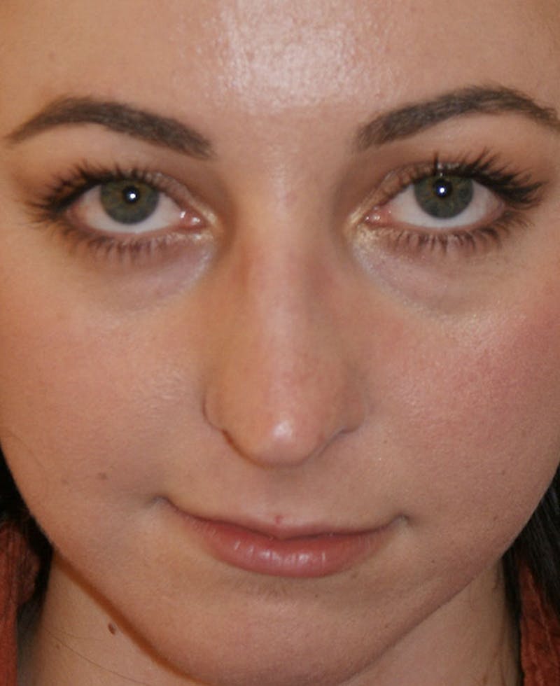 Rhinoplasty Before & After Gallery - Patient 241499 - Image 7