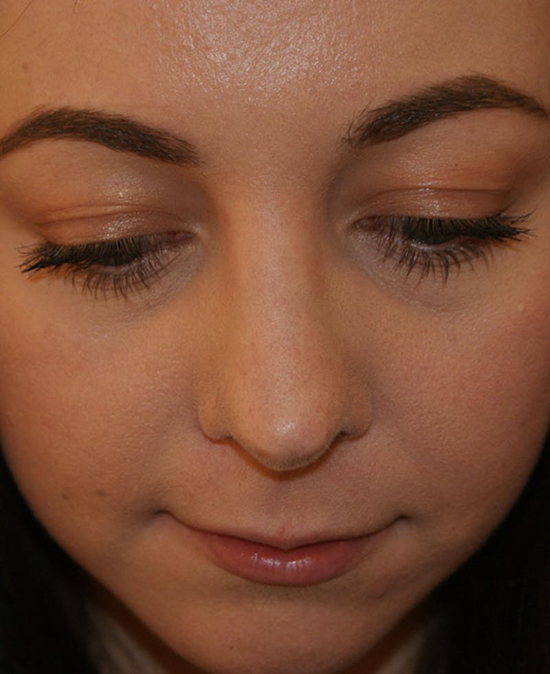 Rhinoplasty Before & After Gallery - Patient 241499 - Image 8