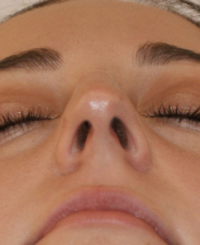 Rhinoplasty Before & After Gallery - Patient 241499 - Image 9