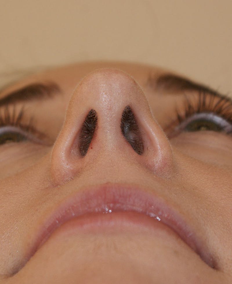 Rhinoplasty Before & After Gallery - Patient 241499 - Image 10
