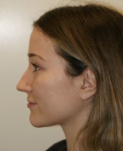 Rhinoplasty Before & After Gallery - Patient 339284 - Image 1