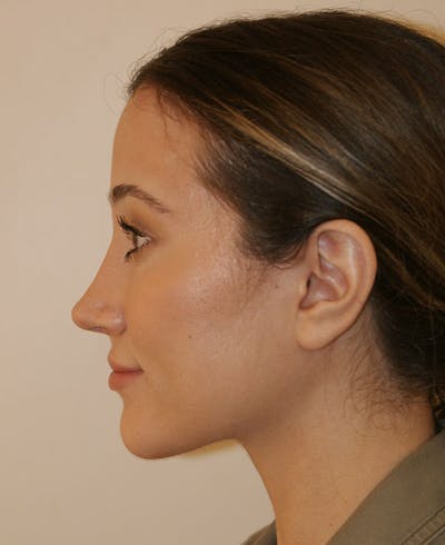Rhinoplasty Before & After Gallery - Patient 339284 - Image 2