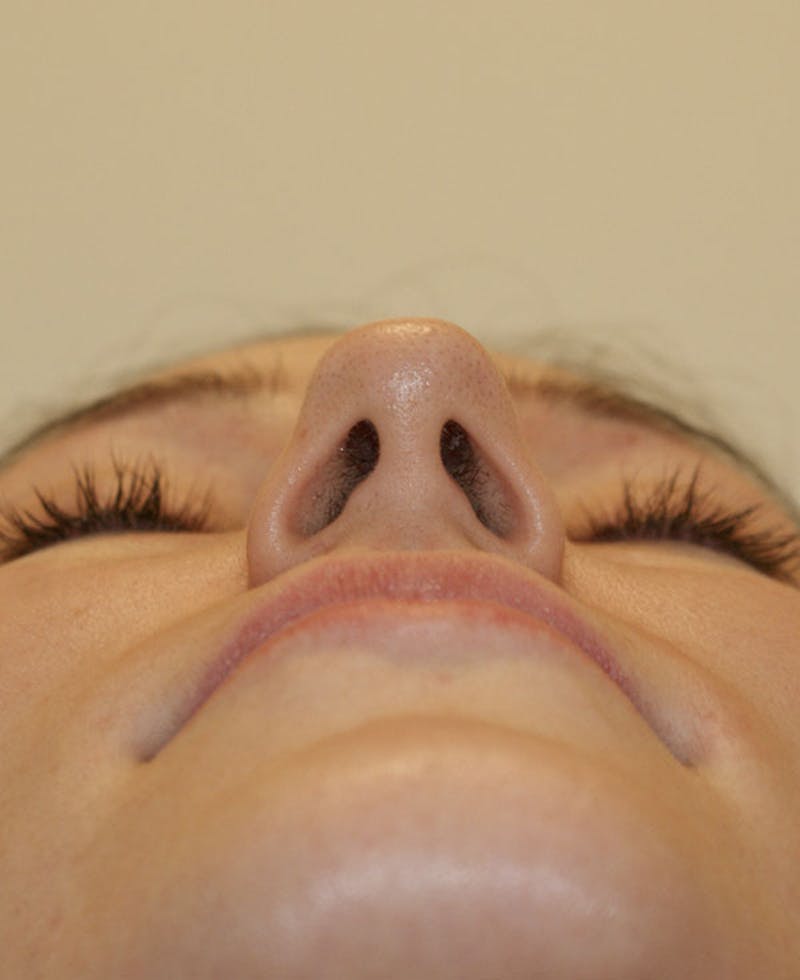 Rhinoplasty Before & After Gallery - Patient 339284 - Image 7