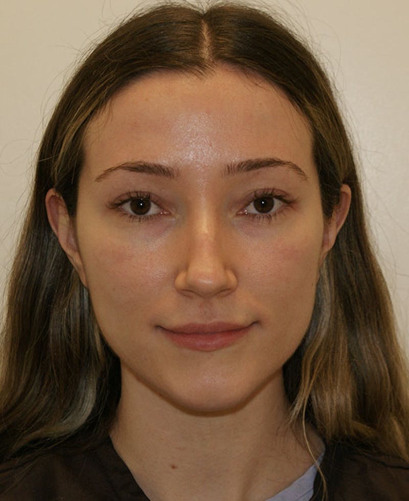 Rhinoplasty Before & After Gallery - Patient 339284 - Image 5