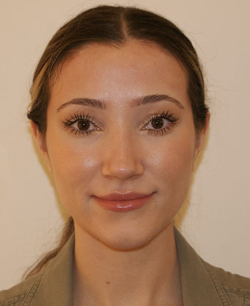 Rhinoplasty Before & After Gallery - Patient 339284 - Image 6
