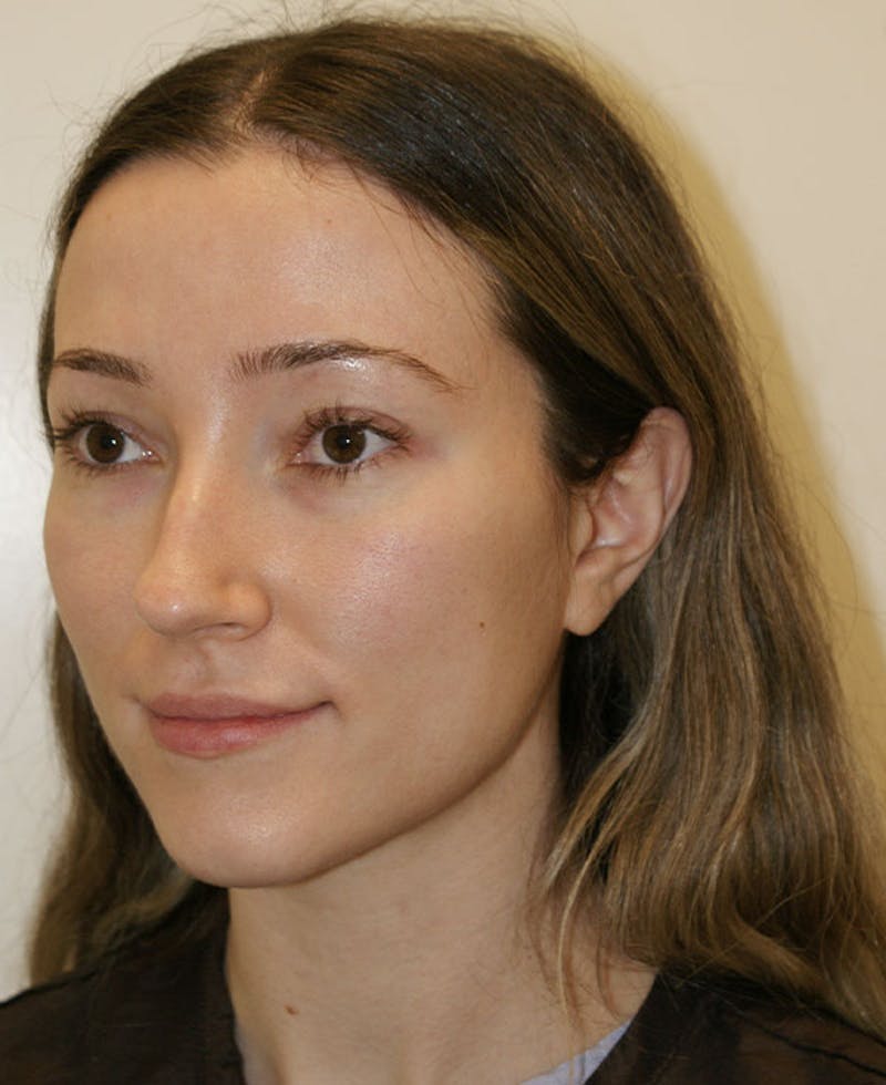 Rhinoplasty Before & After Gallery - Patient 339284 - Image 3