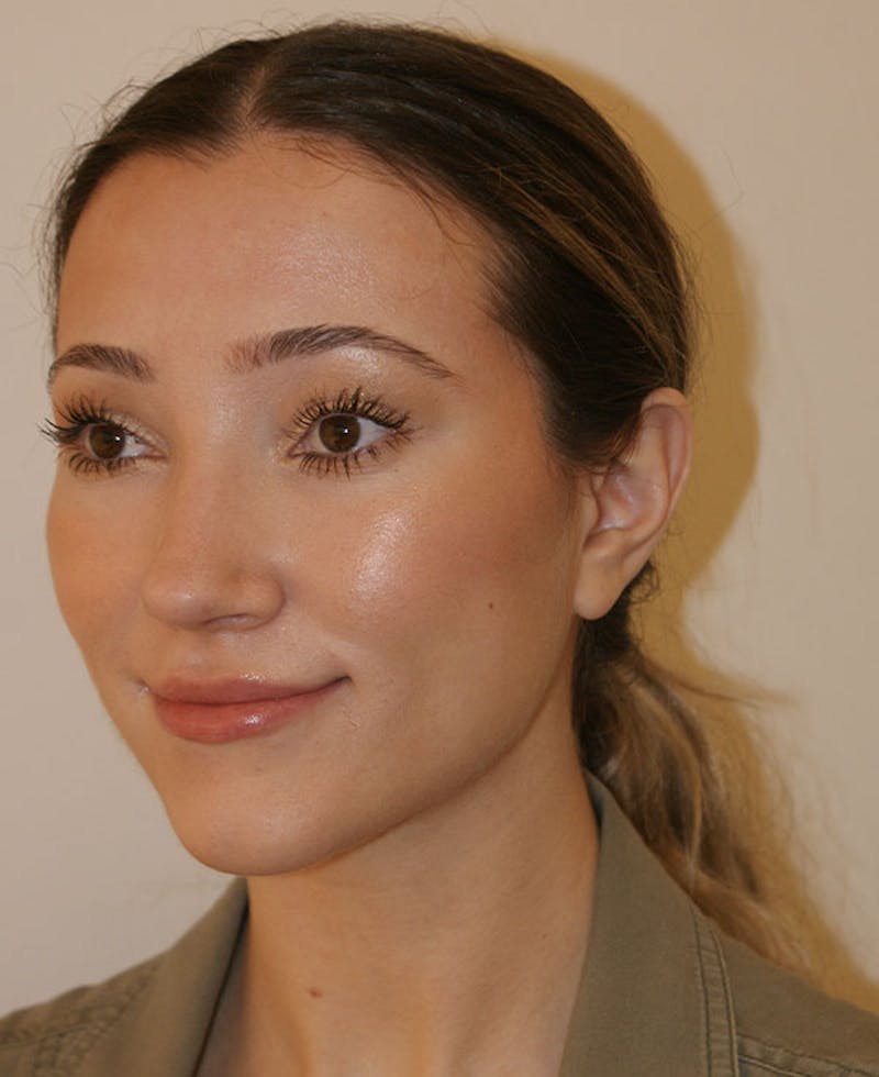 Rhinoplasty Before & After Gallery - Patient 339284 - Image 4