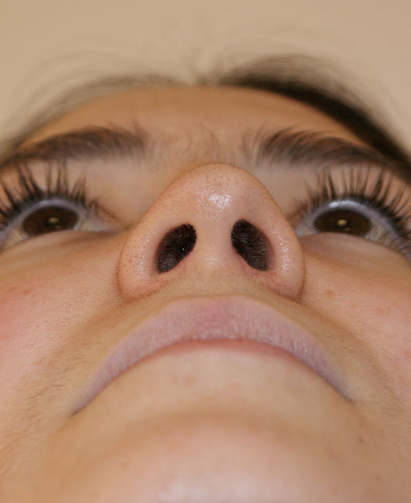 Rhinoplasty Before & After Gallery - Patient 251863 - Image 8