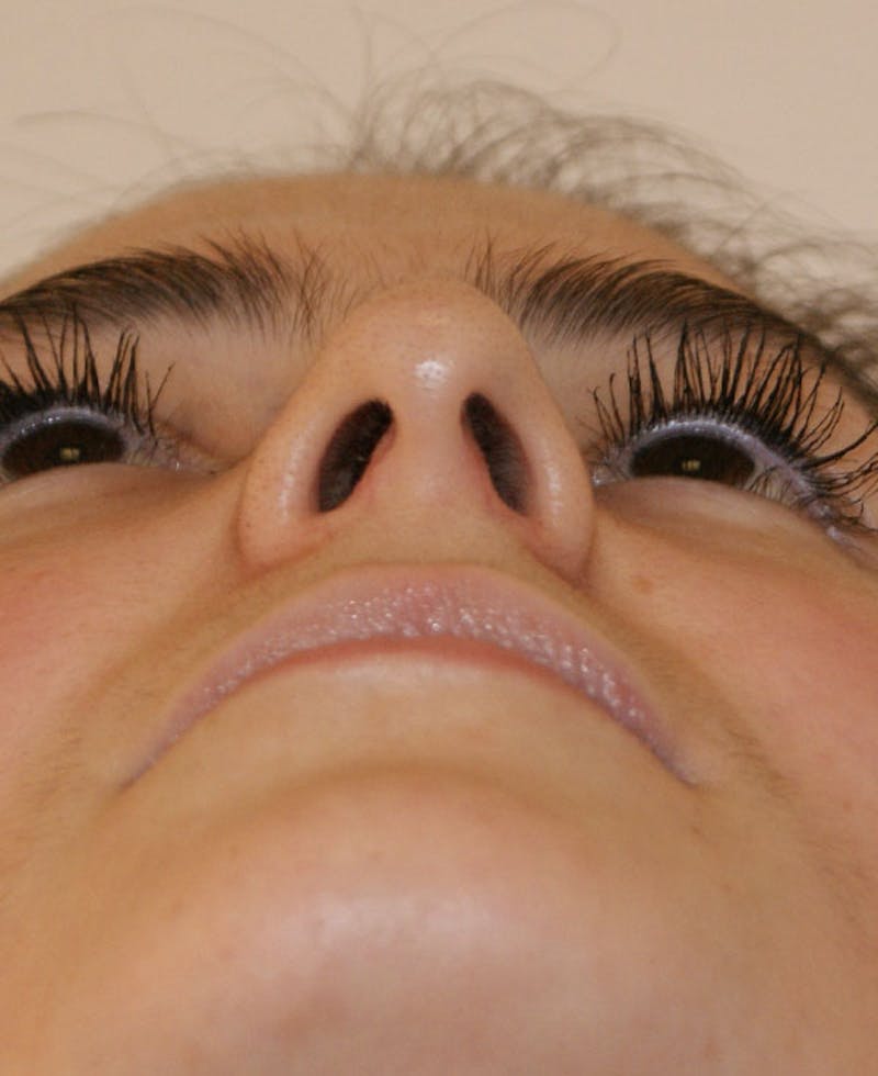 Rhinoplasty Before & After Gallery - Patient 251863 - Image 7