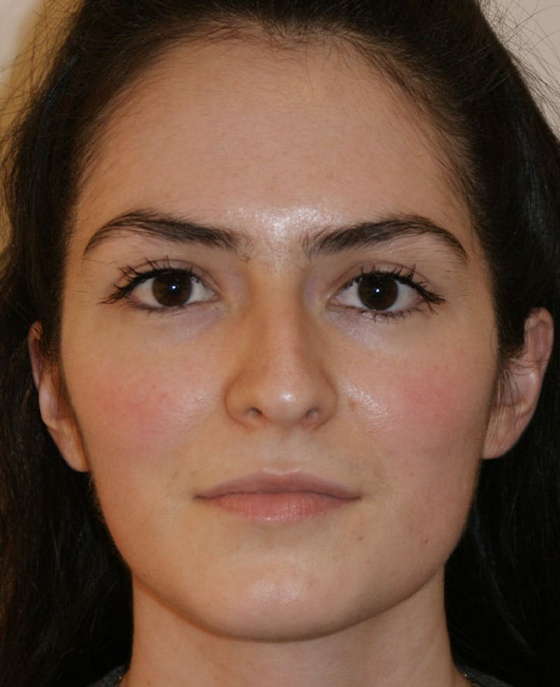 Rhinoplasty Before & After Gallery - Patient 251863 - Image 5