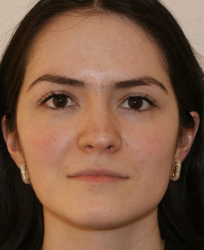 Rhinoplasty Before & After Gallery - Patient 251863 - Image 6