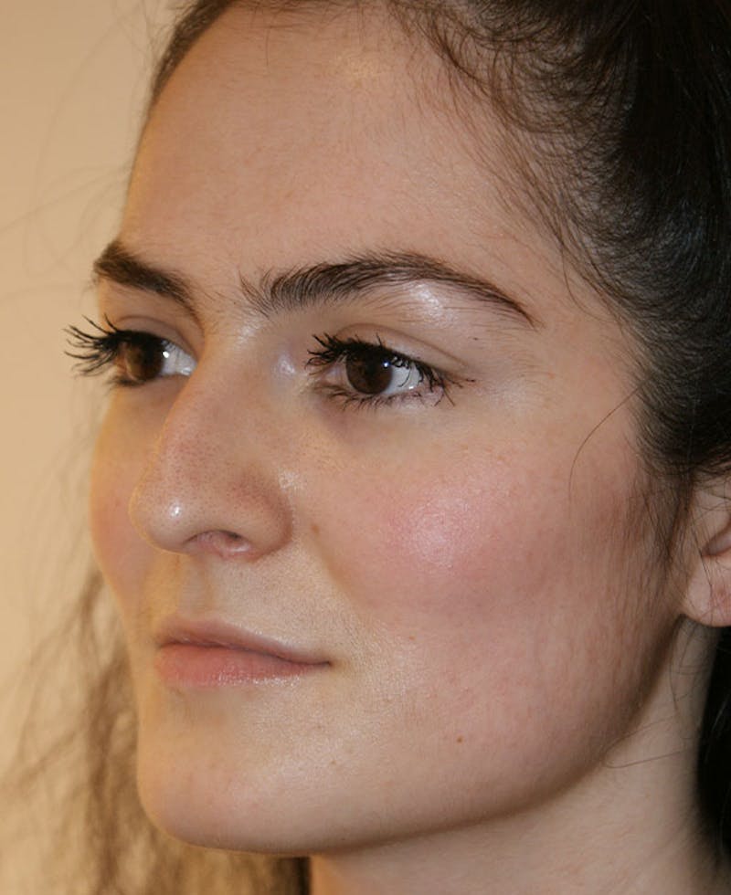 Rhinoplasty Before & After Gallery - Patient 251863 - Image 3