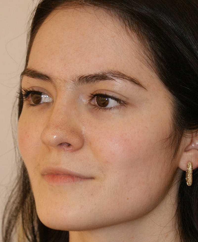 Rhinoplasty Before & After Gallery - Patient 251863 - Image 4