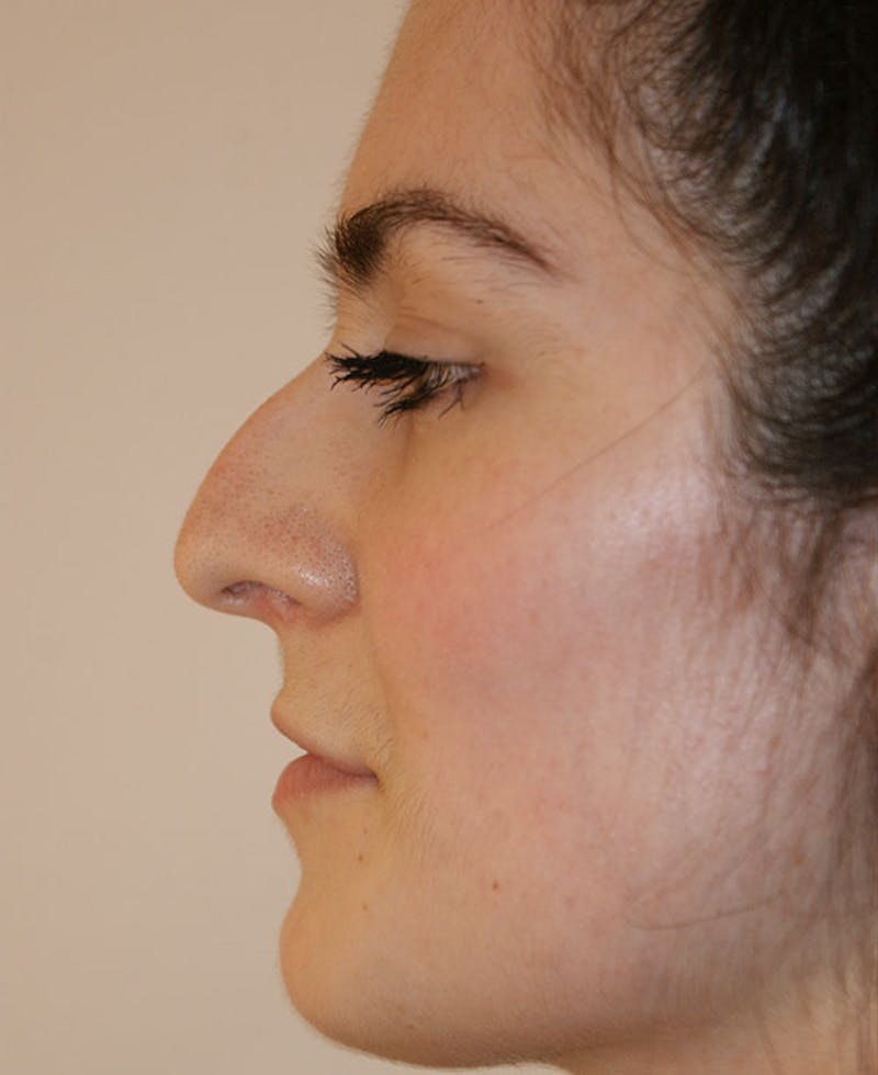 Rhinoplasty Before & After Gallery - Patient 251863 - Image 1